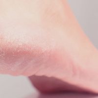 Hiperkeratoza: Ce este și cum poate fi tratată la Magic Feet?