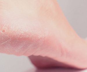 Hiperkeratoza: Ce este și cum poate fi tratată la Magic Feet?