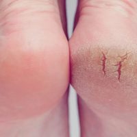 Ragadele: Ce sunt, cum se tratează și cum vă poate ajuta Magic Feet