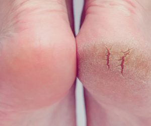 Ragadele: Ce sunt, cum se tratează și cum vă poate ajuta Magic Feet