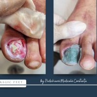 La pacienții cu diabet, o simplă rană la picior poate deveni un pericol real