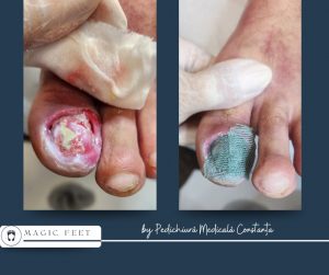 Picior diabetic