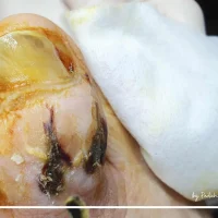 Picior diabetic – evoluție în etape, sub îngrijire specializată Picior diabetic – evoluție în etape, sub îngrijire specializată