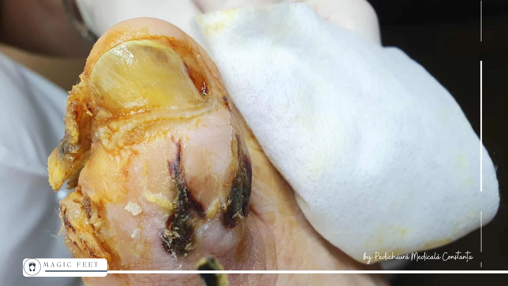 Picior diabetic – evoluție în etape, sub îngrijire specializată