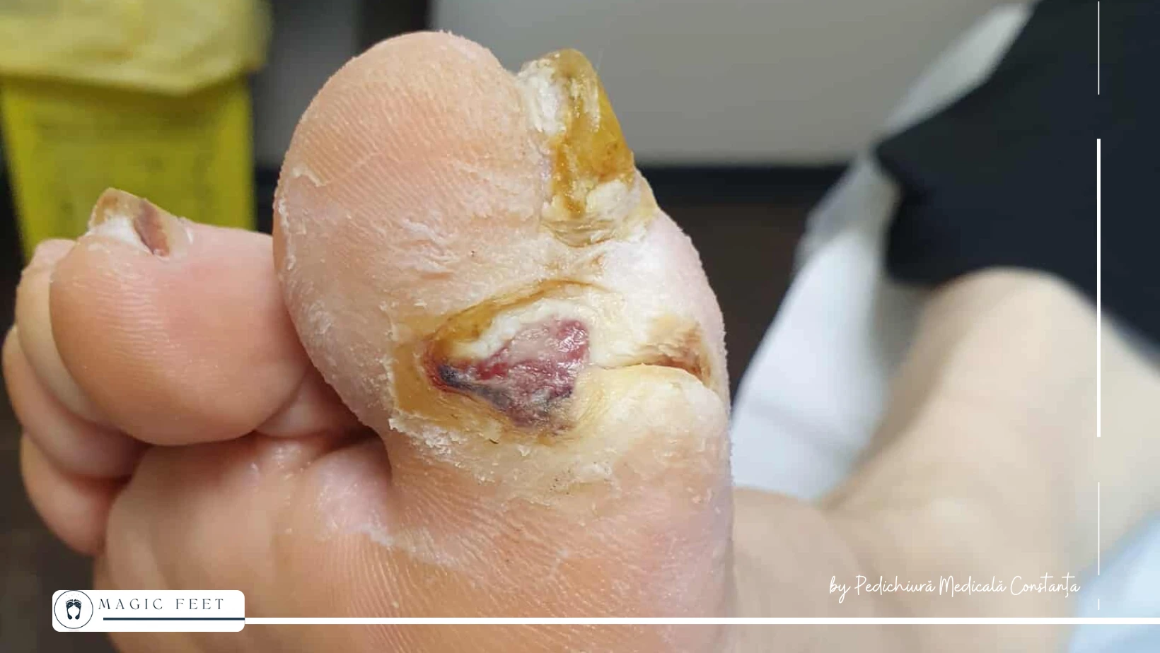 picior-diabetic-2 Îngrijire picior diabetic