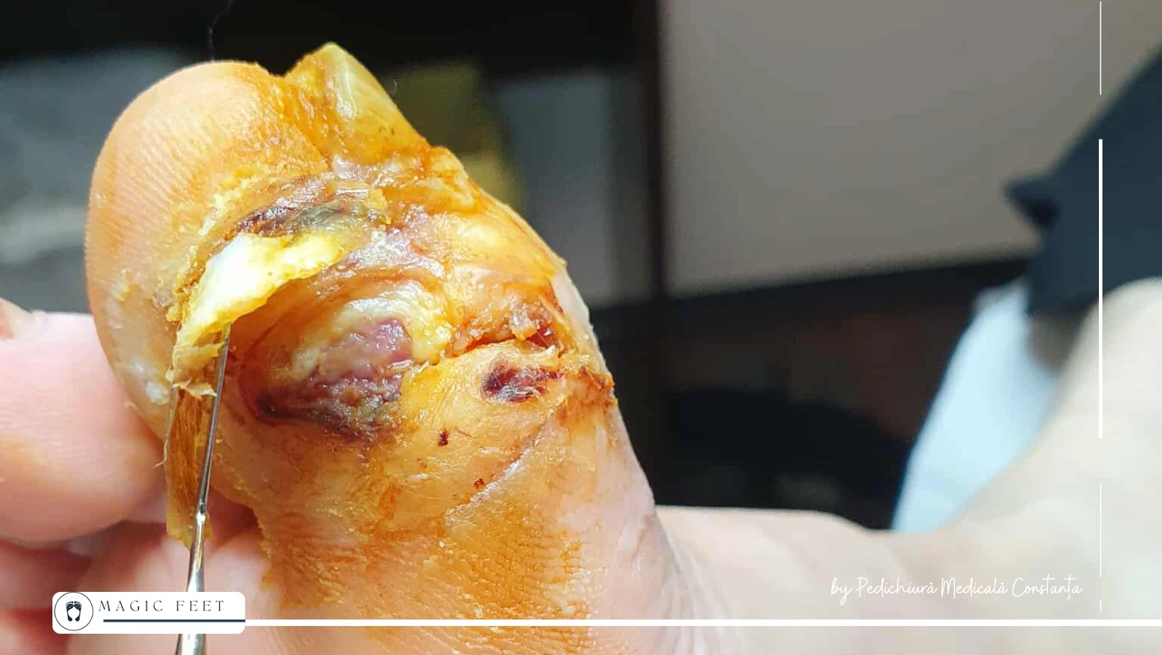 picior-diabetic-3 Îngrijire picior diabetic