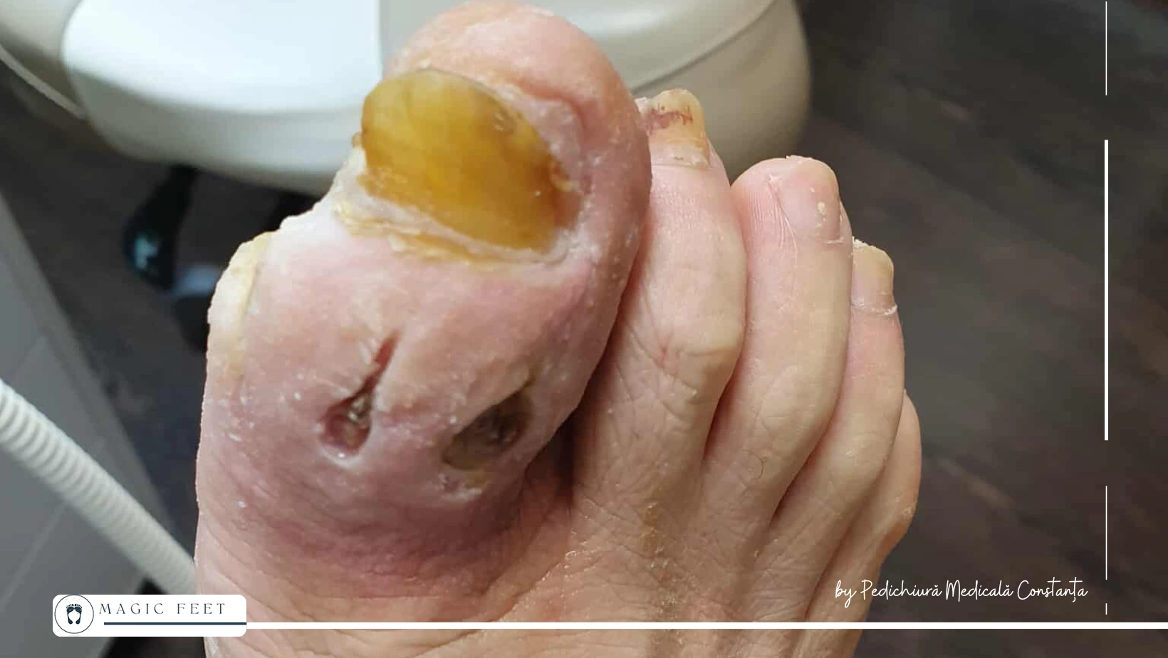 picior-diabetic-4 Îngrijire picior diabetic