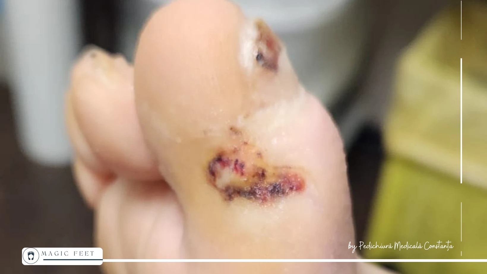 picior-diabetic-5 Îngrijire picior diabetic