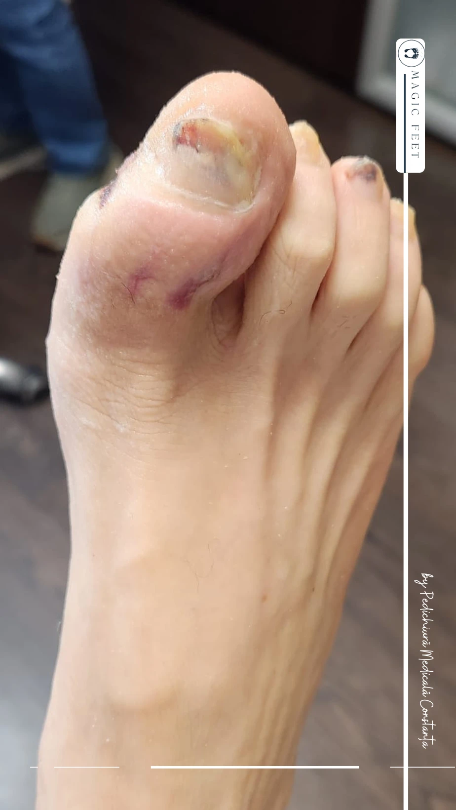 picior-diabetic-6 Îngrijire picior diabetic