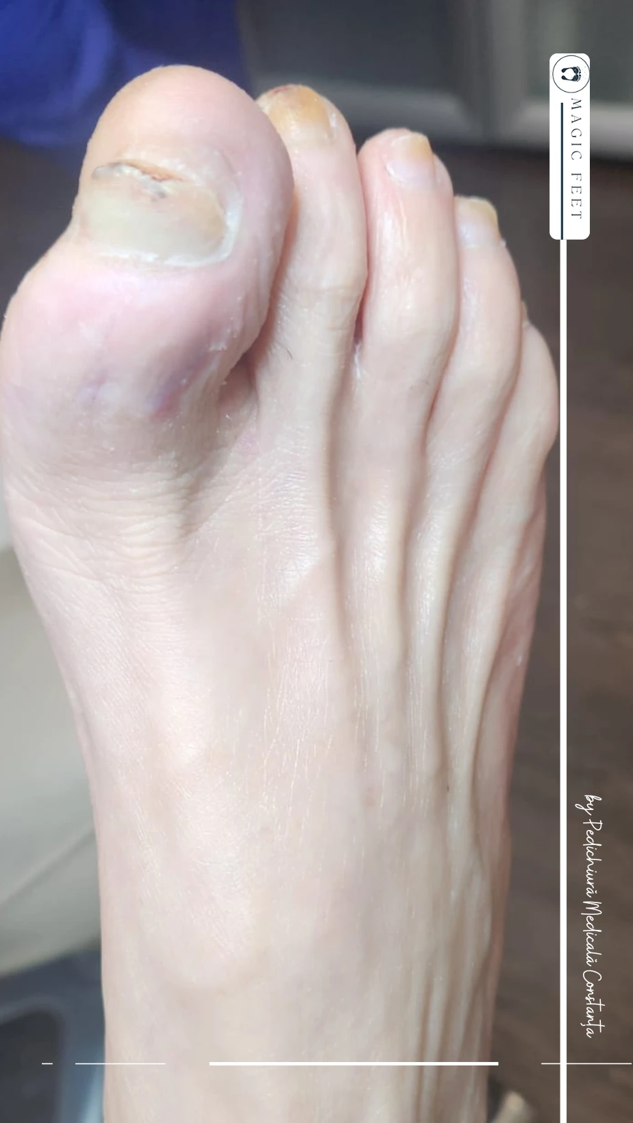 picior-diabetic-7 Îngrijire picior diabetic