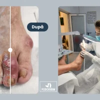 Ulcerație cauzată de deformarea degetelor și încălțăminte nepotrivită Ulcerație cauzată de deformarea degetelor și încălțăminte nepotrivită