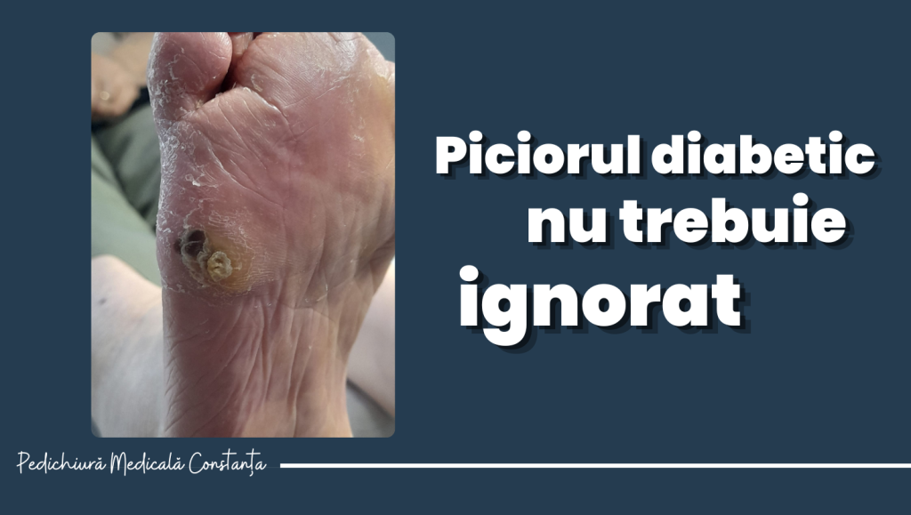 Piciorul diabetic nu trebuie ignorat