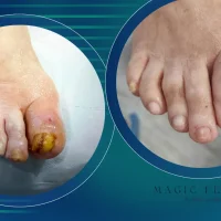 Îngrijirea piciorului diabetic la pacienții vârstnici