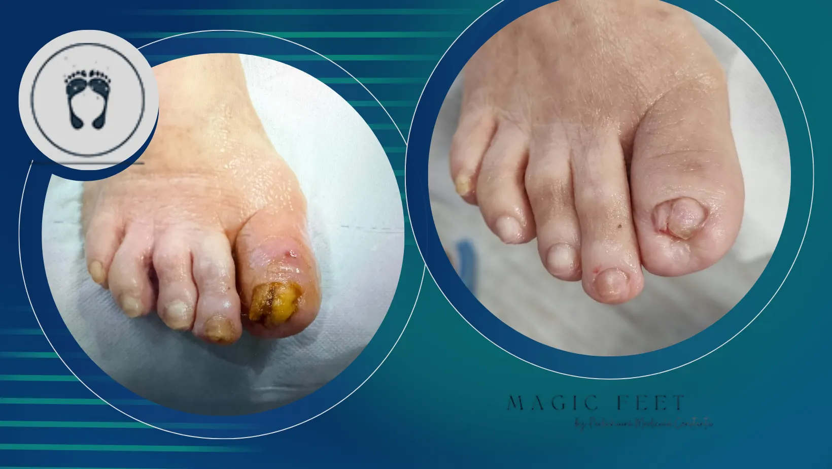 Îngrijirea piciorului diabetic la pacienții vârstnici